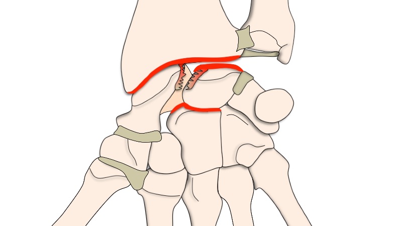 Entorses du poignet Lésions ligamentaires Clinique Ostéo